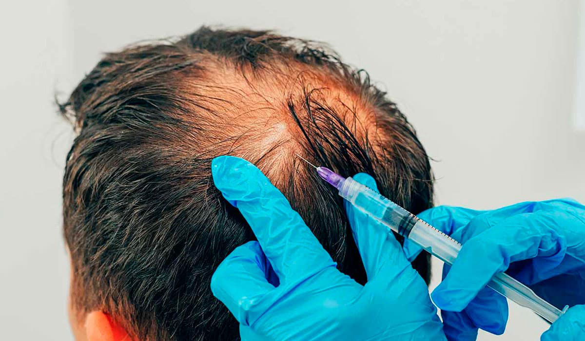 PRP plazma tretman kod pojacanog opadanja kose