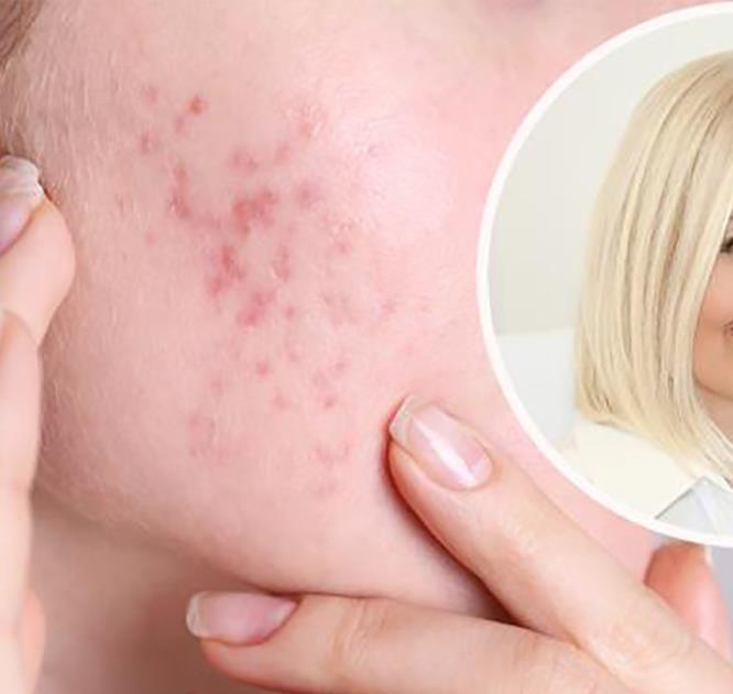 akne kod odraslih osoba